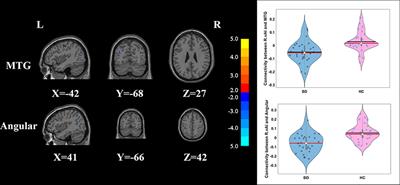 The Insular Subregions Topological Characteristics of Patients With Bipolar Depressive Disorder